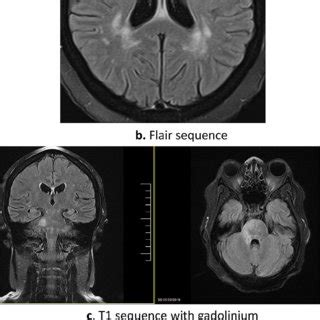 Intraparenchymal lesions. Pontine right lateral lesion that enhances... | Download Scientific ...