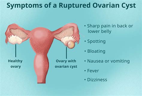 Ruptured Ovarian Cyst Ultrasound