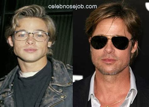 Brad Pitt Botox and Facial Fillers Plastic Surgery Before and After