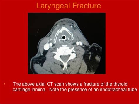 Larynx Imaging 2nd part laryngeal congenital inflammatory traumatic C…