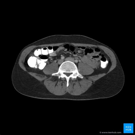 Cara Membaca Ct Scan Abdomen – iFaWorldCup.com