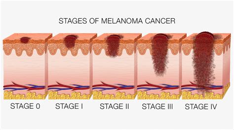 Skin Cancer Melanoma Treatment Causes Stages Early Si - vrogue.co