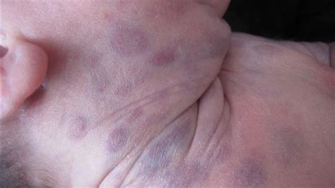 Blueberry Muffin Rash on Babies: Symptoms and Treatment