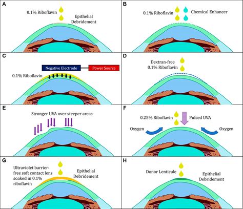 Current Status of Optimized Options Emerging in Cornea Crosslinking