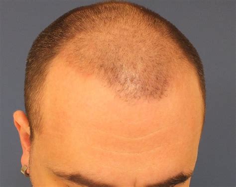 Dr. Ekrem Civas Hair Transplant Turkey. Case 2. 3200 grafts FUE 7months after panosundaki Pin