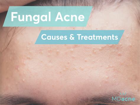 Acne Fungal Infection