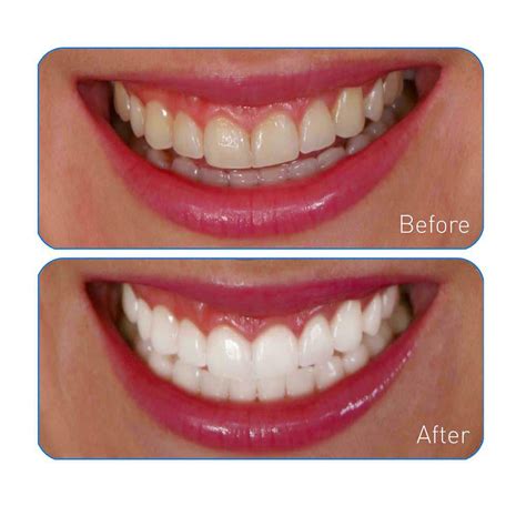 Amazon.com : Go Smile Teeth Whitening System, 20 Count : Tooth ...