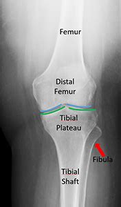 Distal Femur Fracture Classification