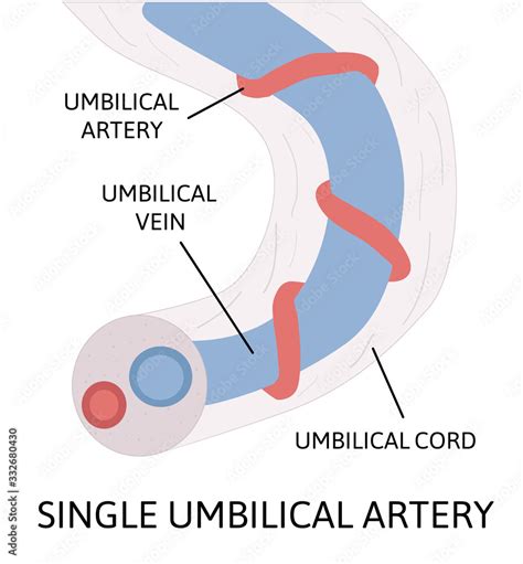 Single umbilical artery. anatomy of umbilical cord with one umbilical artery and one umbilical ...