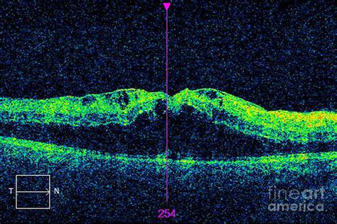 Diabetic Macular Oedema Photograph by Alan Frohlichstein/science Photo Library - Pixels