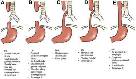 Advances in the Surgical Management of Esophageal Atresia - Advances in Pediatrics