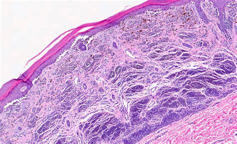 Pathology Outlines - Acral nevus