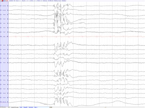 Juvenile Myoclonic Epilepsy - EEGpedia