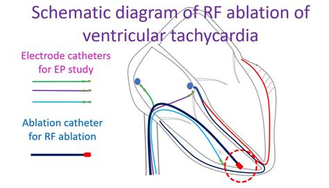 What is RF ablation? – All About Heart And Blood Vessels