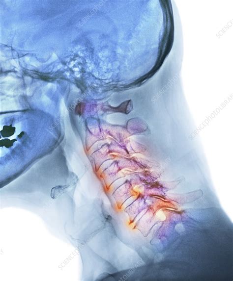 Arthritis of the neck, X-ray - Stock Image - F003/3625 - Science Photo Library