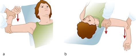 Anterior Shoulder Dislocation