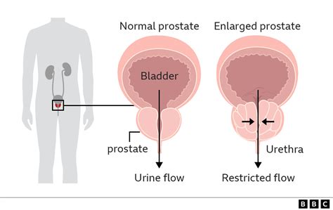 Enlarged prostate: What is it and how to treat it - BBC News