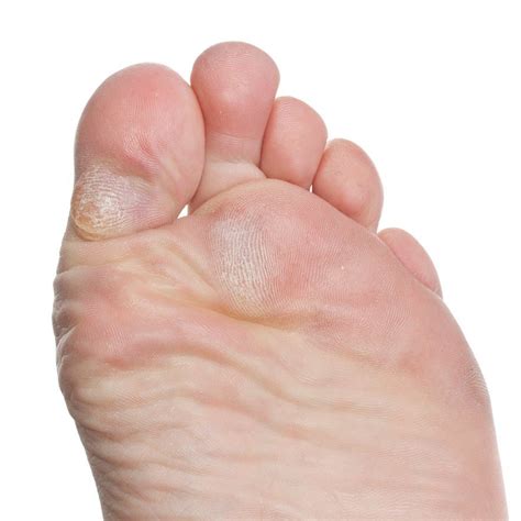 Do Callouses Protect Against Blisters? - Blister Prevention