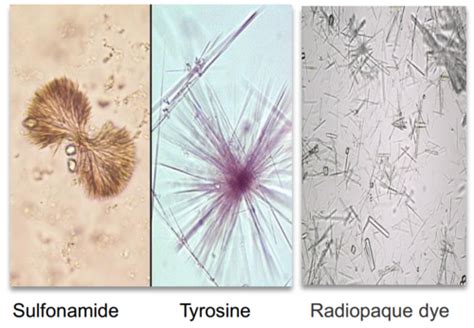 Tyrosine Crystals In Urine