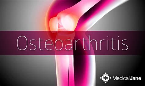 Study: Cannabinoid Therapies for Osteoarthritis Pain