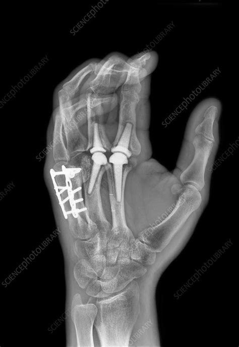 Knuckle replacement, X-ray - Stock Image - C017/7970 - Science Photo Library