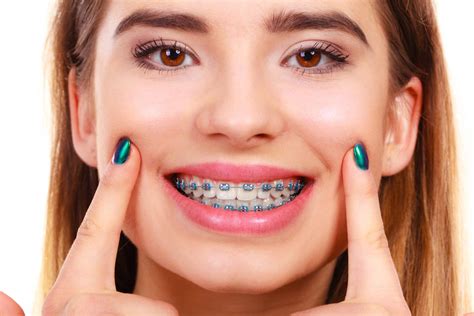 Have fun with your braces! - DE 4 TEENS