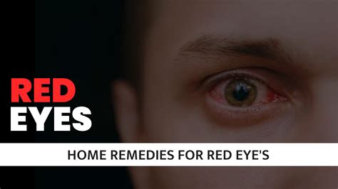 Red Eyes : Best 2 Home Remedies For Red Eyes - Sopan Creation