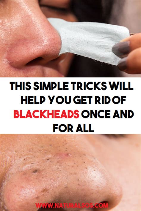 How To Remove A Blackhead: A Complete Guide - IHSANPEDIA