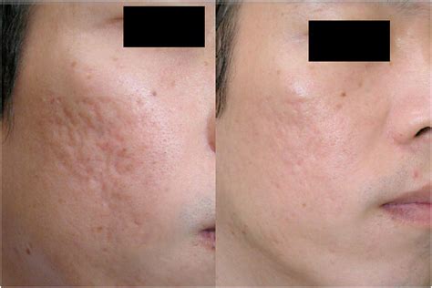 Dermaroller Before and After #8 | Acne scarring on cheek bef… | Flickr