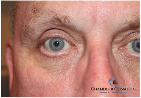 Eyelid Cyst Removal Surgery | Face Mole Removal | Dr. Chandler