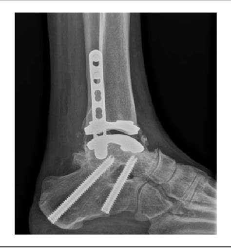 Figure 1 from Clinical Outcome and Fusion Rate Following Simultaneous Subtalar Fusion and Total ...