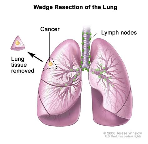 Non-Small Cell Lung Cancer Treatment - NCI