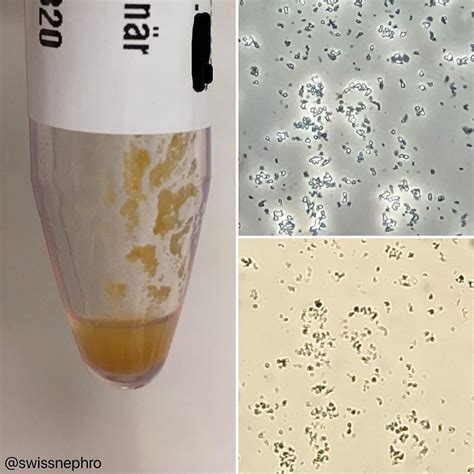 Pin auf urine rotine analysis