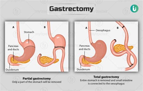 Subtotal Gastrectomy