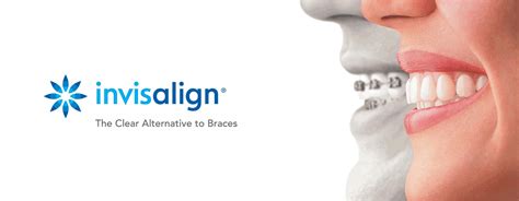 About Invisalign | Dutch Hill Family Dental