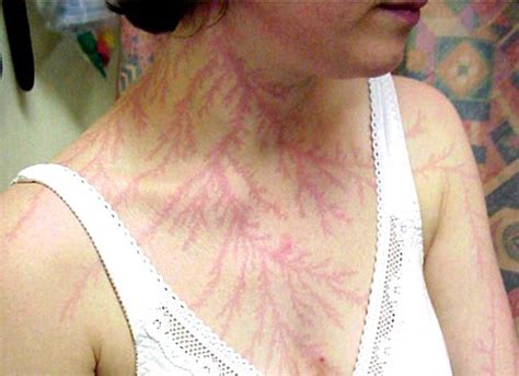 A woman who was struck by lightening displays her body "fractals.” You can find fractals across ...