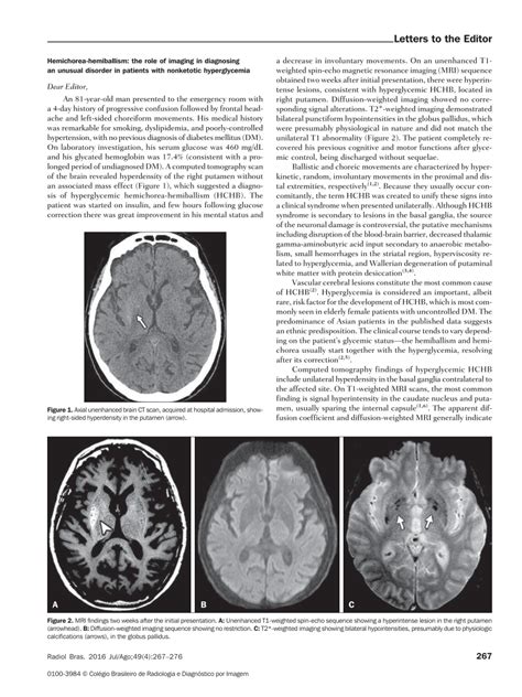 (PDF) Hemichorea-hemiballism: the role of imaging in diagnosing an unusual disorder in patients ...