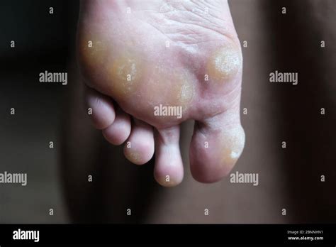 Foot fungus, tinea pedis, fungal infection.dermatology disease. leg ...