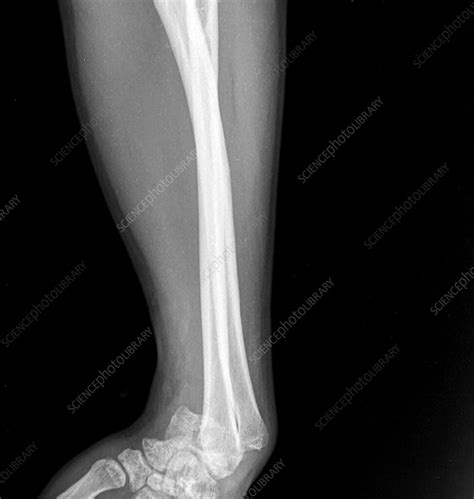 Dislocated wrist, X-ray - Stock Image - F035/6031 - Science Photo Library