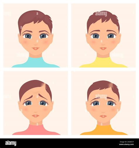 Female alopecia stages, illustration Stock Photo - Alamy