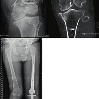 (PDF) Management of Distal Femoral Fractures