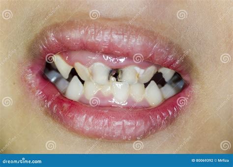 Rotten Teeth. Royalty-Free Stock Image | CartoonDealer.com #35981548