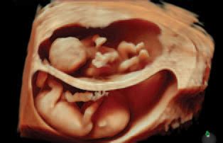 3D/4D Ultrasound | Expert Pregnancy Imagining :: Minnesota Women's Care ...