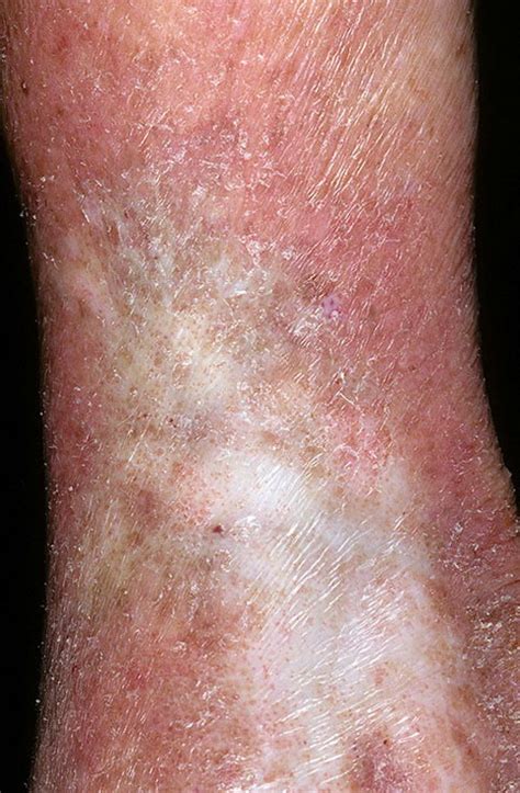 Venous Eczema on Legs Pictures – 174 Photos & Images / illnessee.com