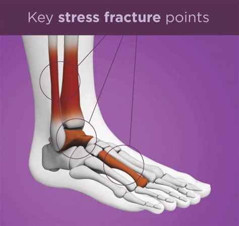 Stress Fractures: Causes, Treatment, and Prevention | UPMC HealthBeat