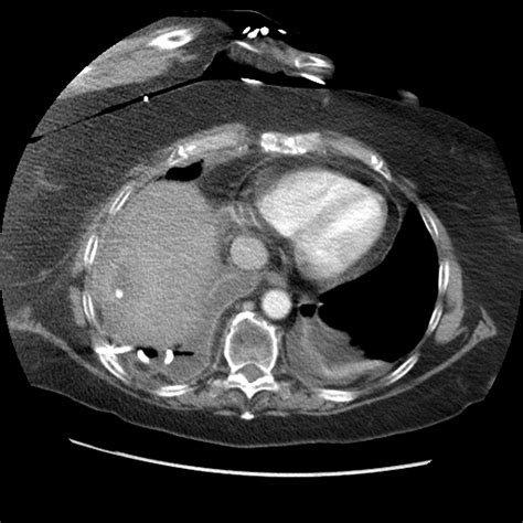 Appendix Fecalith 1376 Farnham Liver And Empyema | Surgery Photos