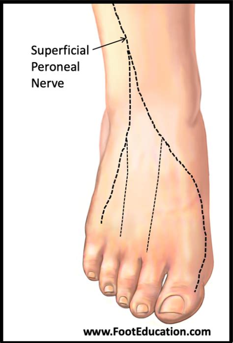 Superficial Peroneal Neuritis - FootEducation