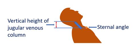 Jugular venous pulse (JVP) – All About Cardiovascular System and Disorders