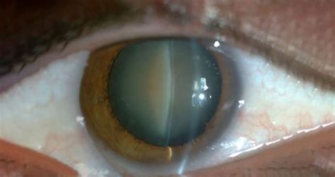 Symptoms, causes and treatment for congenital cataracts