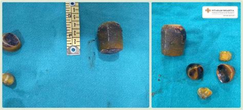 Gallbladder Stone Surgery: When do you need treatment?